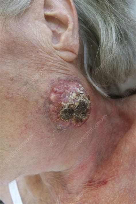 It starts in the merkel cells, which are usually in the top layer of the skin (the epidermis). Merkel cell carcinoma - Stock Image - C045/9571 - Science ...