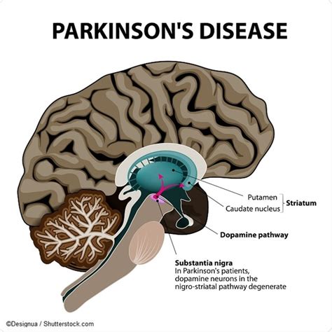 Parkinsons Disease Pathophysiology