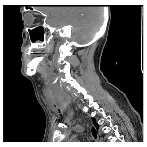 Computed Tomography Neck Without Contrast Coronal View Showing Right