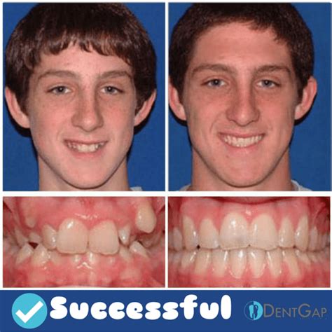 Images Luxury Face Change Before And After Braces
