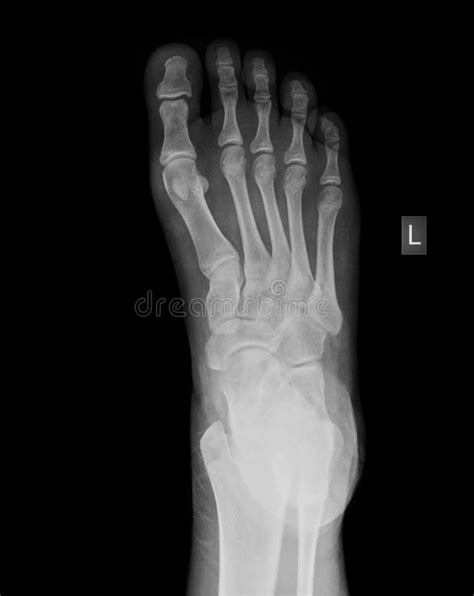 X Ray Of Foot X Ray Of Human Foot Aff Ray Foot Human Ad X