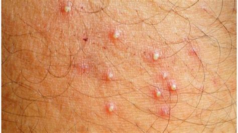 Folliculitis Vs Herpes Symptoms Causes Pictures Differences