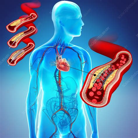 Angioplasty With Stent Placement Illustration Stock Image C046