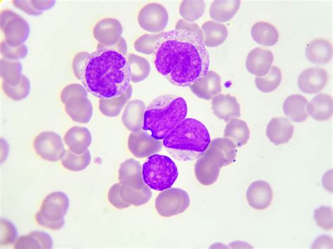 The Latest News And Updates In Acute Myeloid Leukemia Cure Today