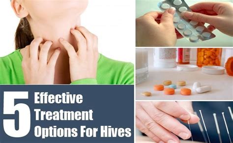 Treatment For Hives Check More At Hives