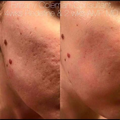 Acne Scars Before And After Retinol Before And After