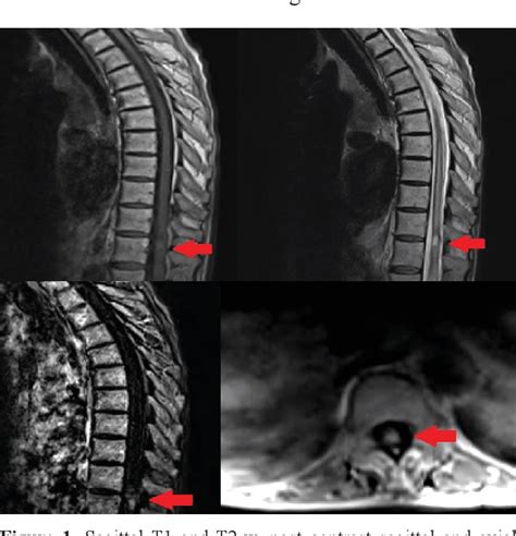 Figure 1 From Intramedullary Spinal Cord Metastasis Of Lung Cancer