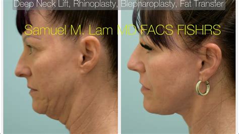 Deep Neck Lift Deep Plane Facelift Rhinoplasty Upper Lower