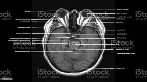 Normal Brain Anatomy Mri Stock Photo Download Image Now Anatomy