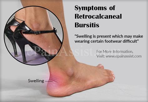 Retrocalcaneal Bursitis Or Achilles Tendon Bursitiscausessymptoms