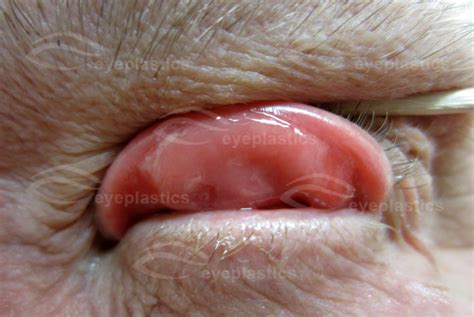 Search and browse our complete effect list of instagram filters in our ig effect gallery. Floppy eyelid syndrome | Eye Lid Laxity | ectropion ...