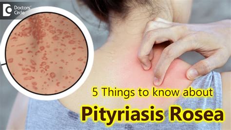 Pityriasis Rosea Treatment