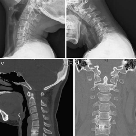 Lateral Flexion Extension Cervical Spine Radiographs A B And