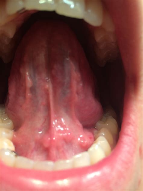 I Have Had Swelling Under My Tongue As Well As Many Pimple Like Bumps