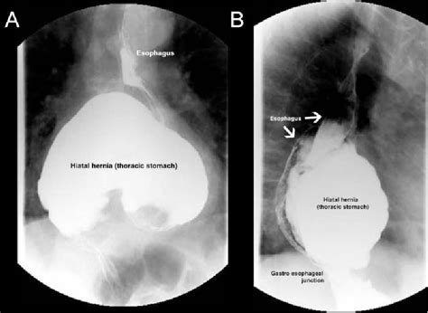 Figure 1 From Images In Cardiovascular Medicine Massive Hiatal Hernia