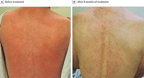 Treatment Of Refractory Pityriasis Rubra Pilaris With Novel Pde4