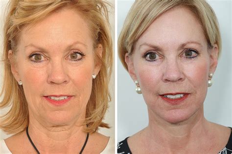 Top Celebrity Face Lift Surgeon Natural Looking Facelift For Women In Manhattan Upper East