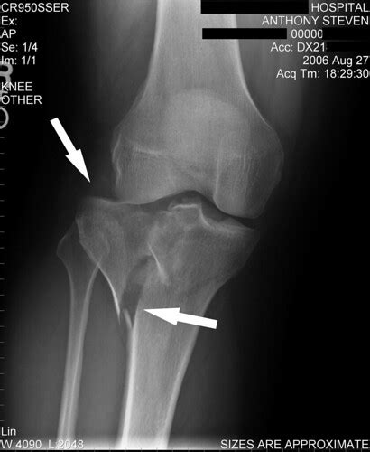 Fracture Tibial Plateau August Fractured Tibia P Flickr