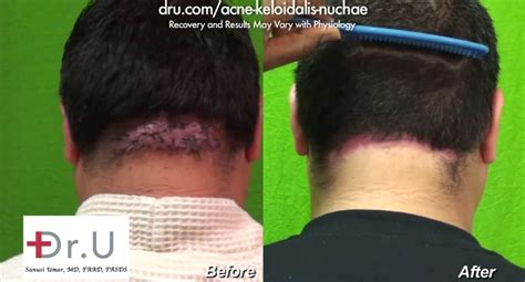 Treating Large Acne Keloidalis Nuchae Bumps With Drus Innovative