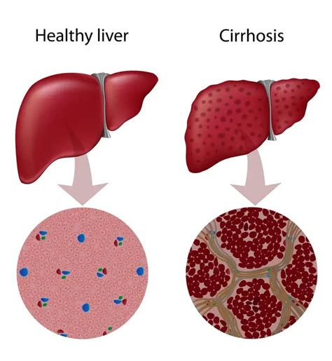 Types Of Cirrhosis