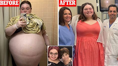 Florida Woman Had 100 Lb Ovarian Cyst Surgically Removed Allowing Her To Feel Like A Person Again