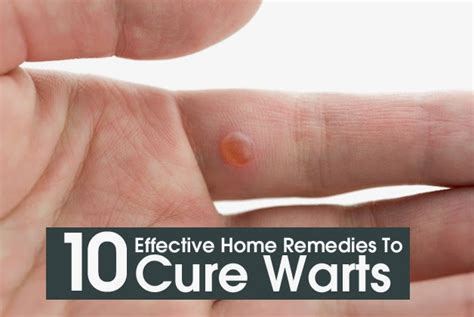 10 Effective Home Remedies To Cure Warts ~ Mzizi Mkavu