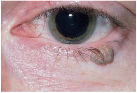Benign Tumors Of The Eyelid Epidermis Ento Key