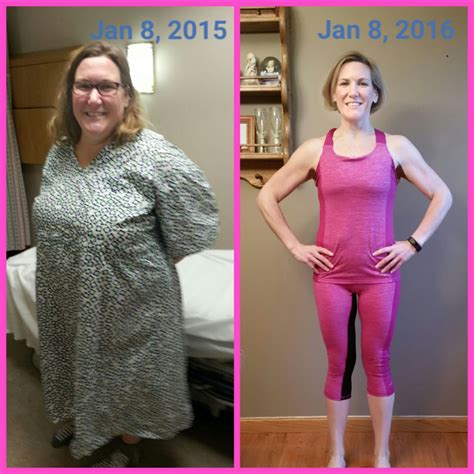 Before And After 1 Year Gastric Sleeve Anniversary Member Photo