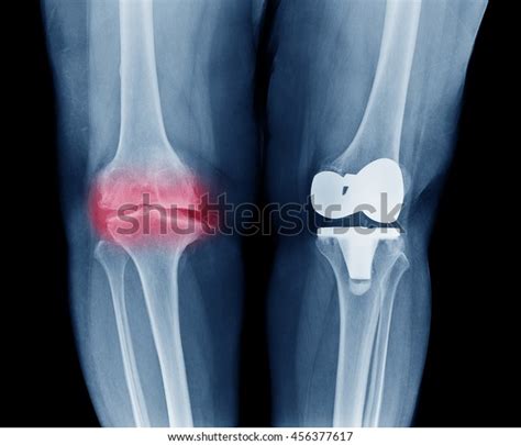 Knee Osteoarthritis X Ray Stock Image C Science Photo My Xxx Hot Girl