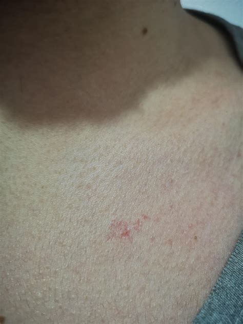 I Have This Red Thing Right Below My Neck It S Not Bothering Me Not