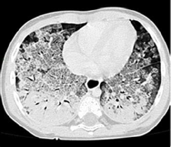 Radiological Manifestations Of Serious Exogenous Lipoid Pneumonia Case