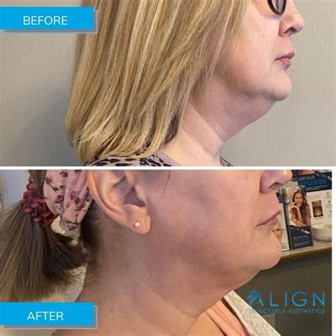 Double Chin Removal And Jowl Treatments With Agnes Rf Align