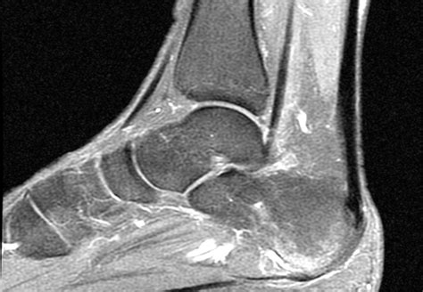 They are located subjacent to the 1st metatarsal diaphysis 1st metatarsal head proximal phalanx of no acute muscle or tendon strain. Plantar fasciitis | Image | Radiopaedia.org