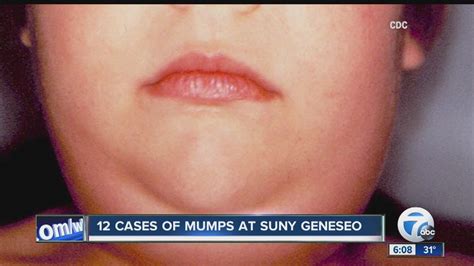 Mumps At Suny Geneseo Youtube