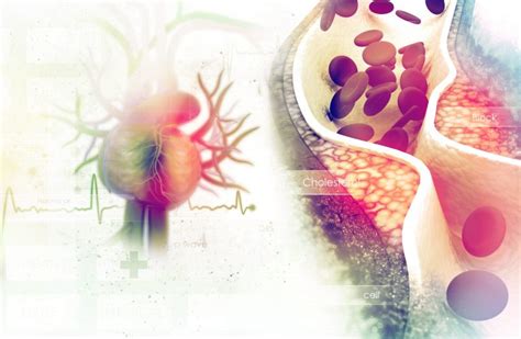 Czym Jest Choroba Niedokrwienna Serca Jakie S Jej Przyczyny Objawy I