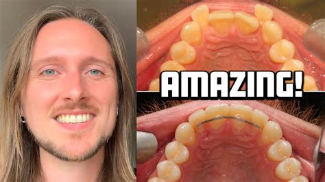 Invisalign My Incredible Clinical Photos Before And After Youtube