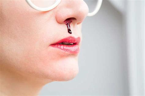 Epistaxis Nasal Hemorrhage Nosebleed Bloody Nose Anterior Bleed My