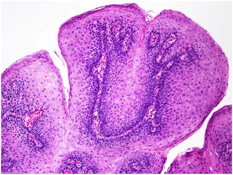 Esophageal Squamous Cell Papilloma The Journal Of Pediatrics