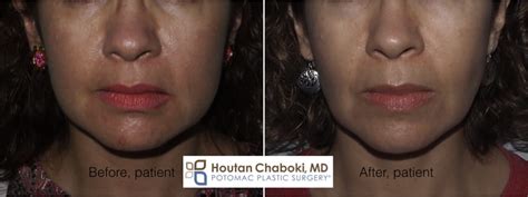 Contouring Cheeks With Fat Reduction