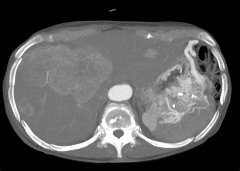 Metastatic Neuroendocrine Tumor Of The Tail Of The Pancreas With Liver