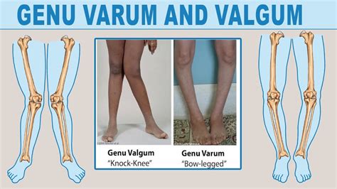 Genu Varum And Valgum Causes Symptoms And Effective Treatments YouTube