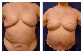 Breast Reconstruction Following Fat Transfer Our Surgical Team
