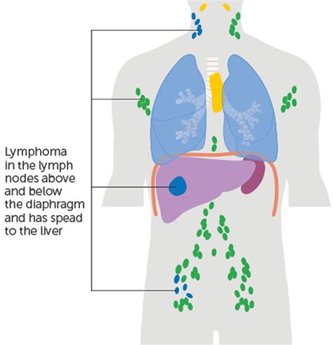 Non Hodgkin Lymphoma Causes Symptoms Diagnosis Treatment And Prognosis