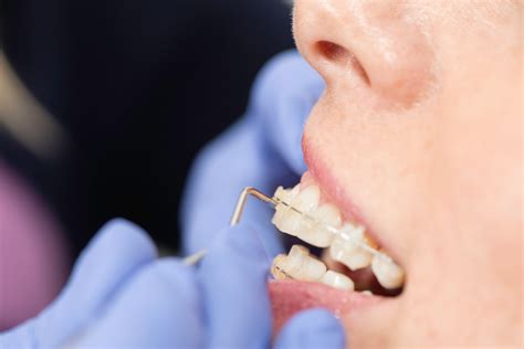 What To Expect When You Get Your Braces Off Hardy Pediatric Dentistry