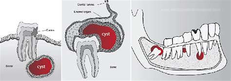The Most Common Oral Cysts Dr Jamilian