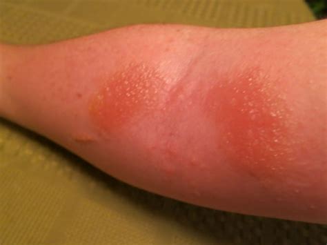 How Long Until Poison Ivy Rash Appears Detailed Guidelines