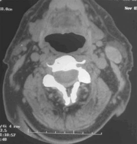 Warthin Tumor A Common Benign Tumor Presenting As A Highly Suspicious