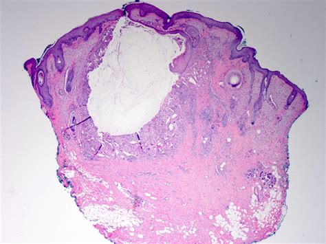 Epidermal Inclusion Cyst Histology