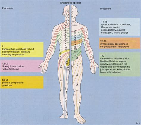 Neuraxial Blocks Spinal And Epidural Anesthesia Anesthesia Key