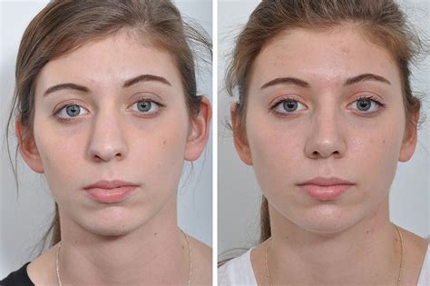 Learn The Trending Techniques About Secured Nose Job Boston Nose Plastic Surgery Nose Surgery